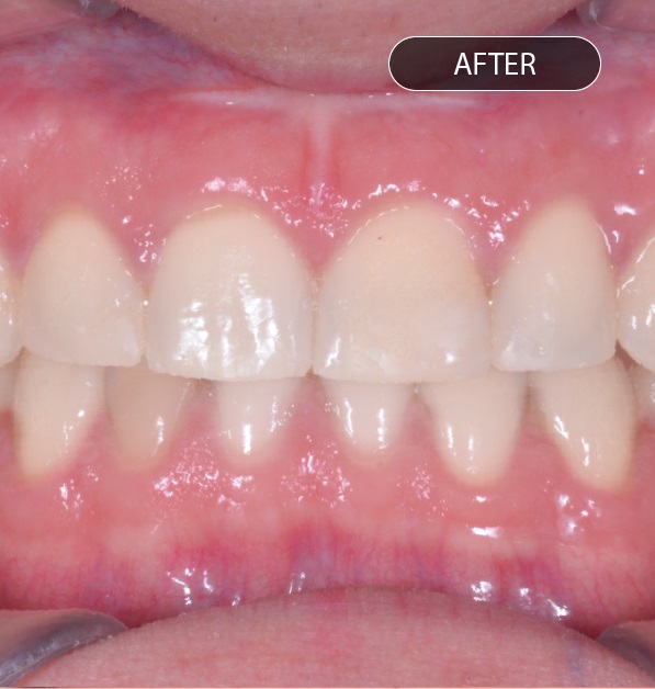 Depois do tratamento de ortodontia